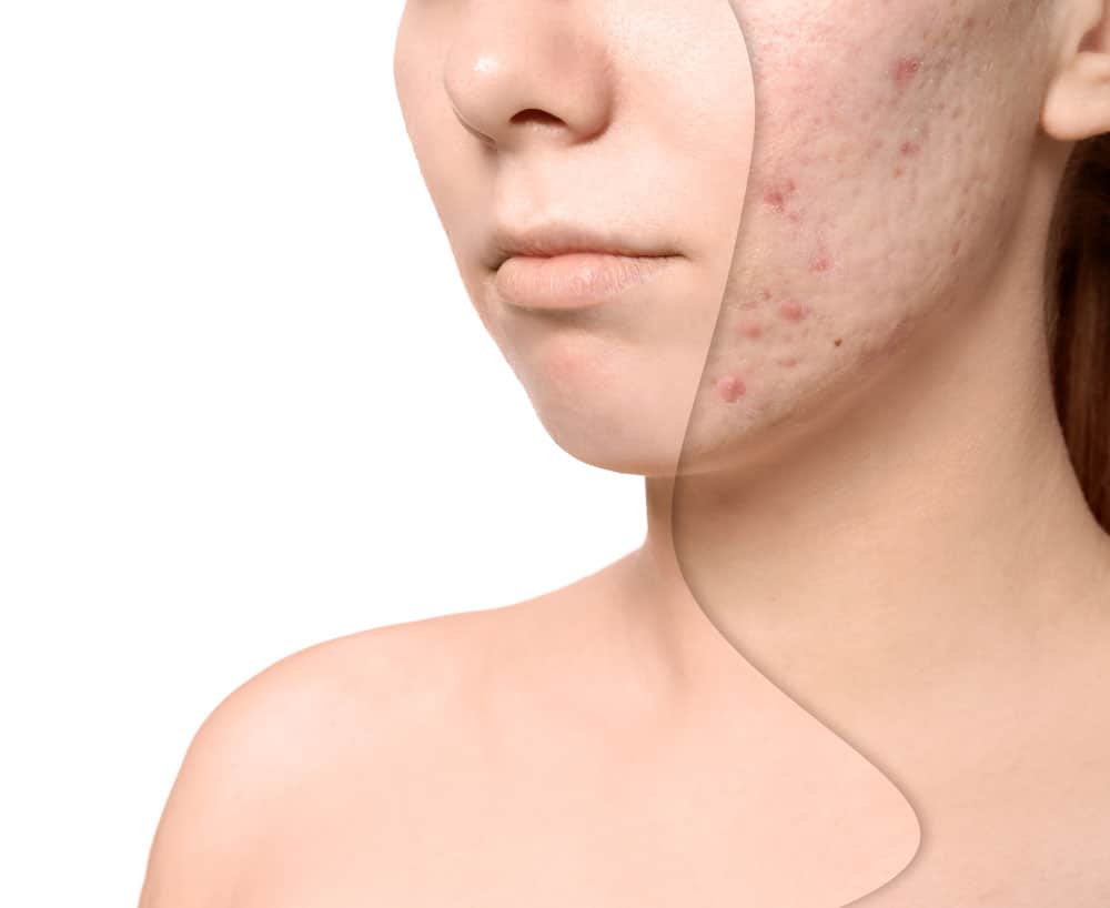 acne scar before and after treatment and removal