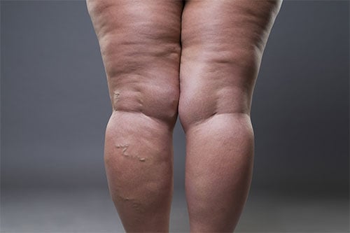 photo of a women with a cellulite grade 3 issue