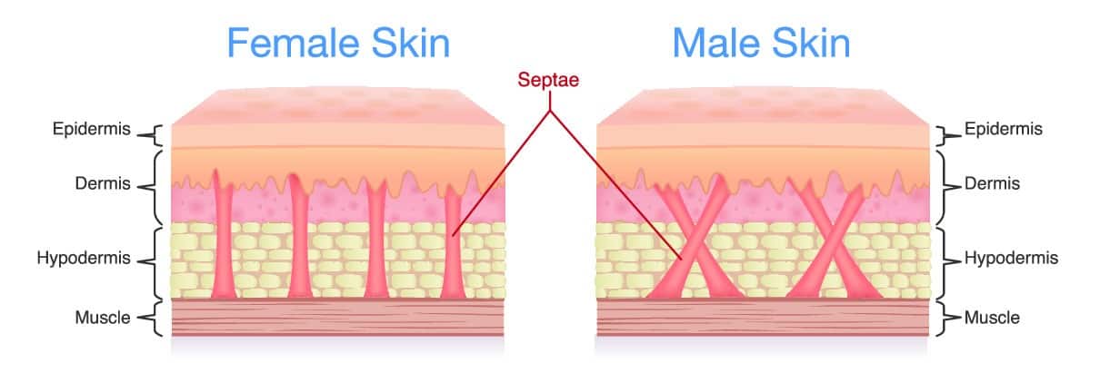 Difference between female and male skin which can cause cellulite