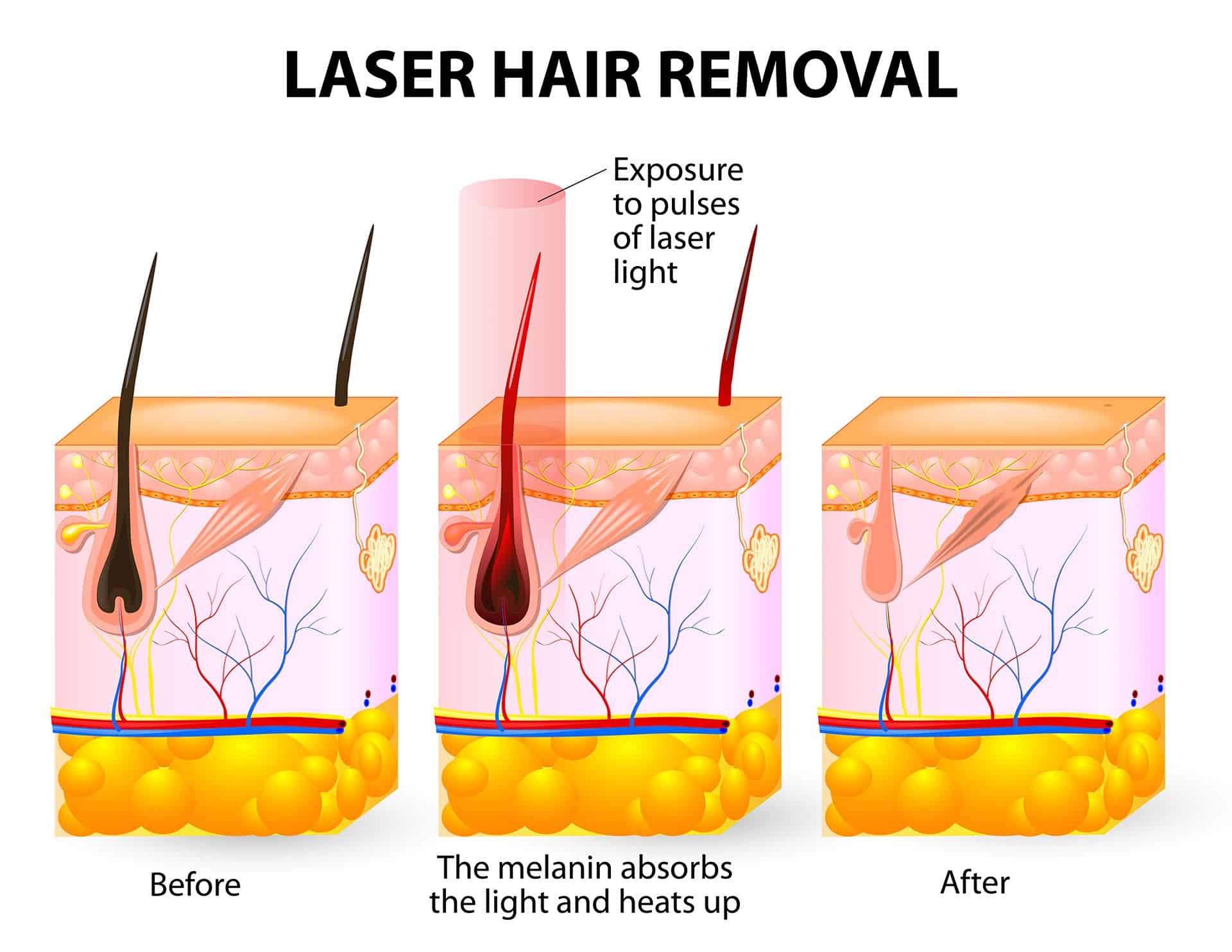 IPL and laser hair removal