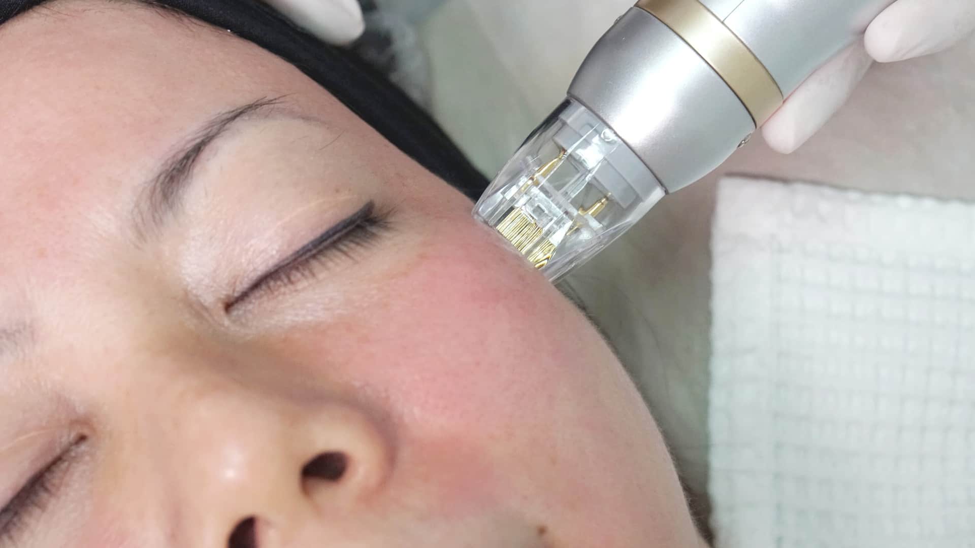 a lady getting her Sylfirm X microneedling treatment