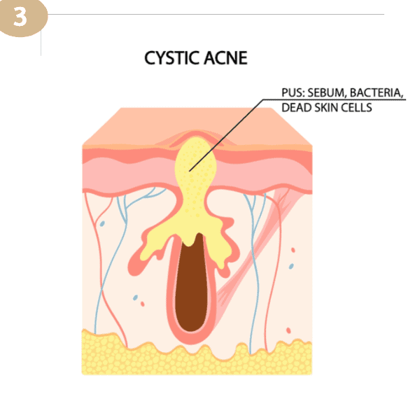 types of acne and pimple and how to treat them