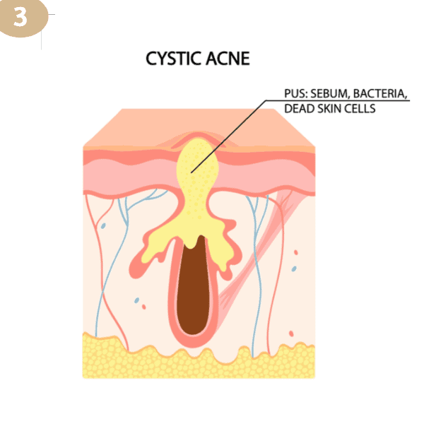 Cystic Acne Removal Ensoul Clinic