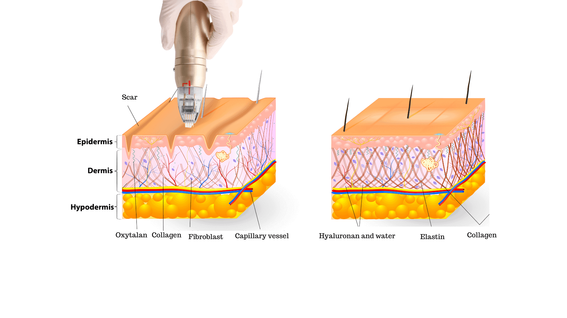 diagram of a sylfirm microneedling effectiveness on the skin