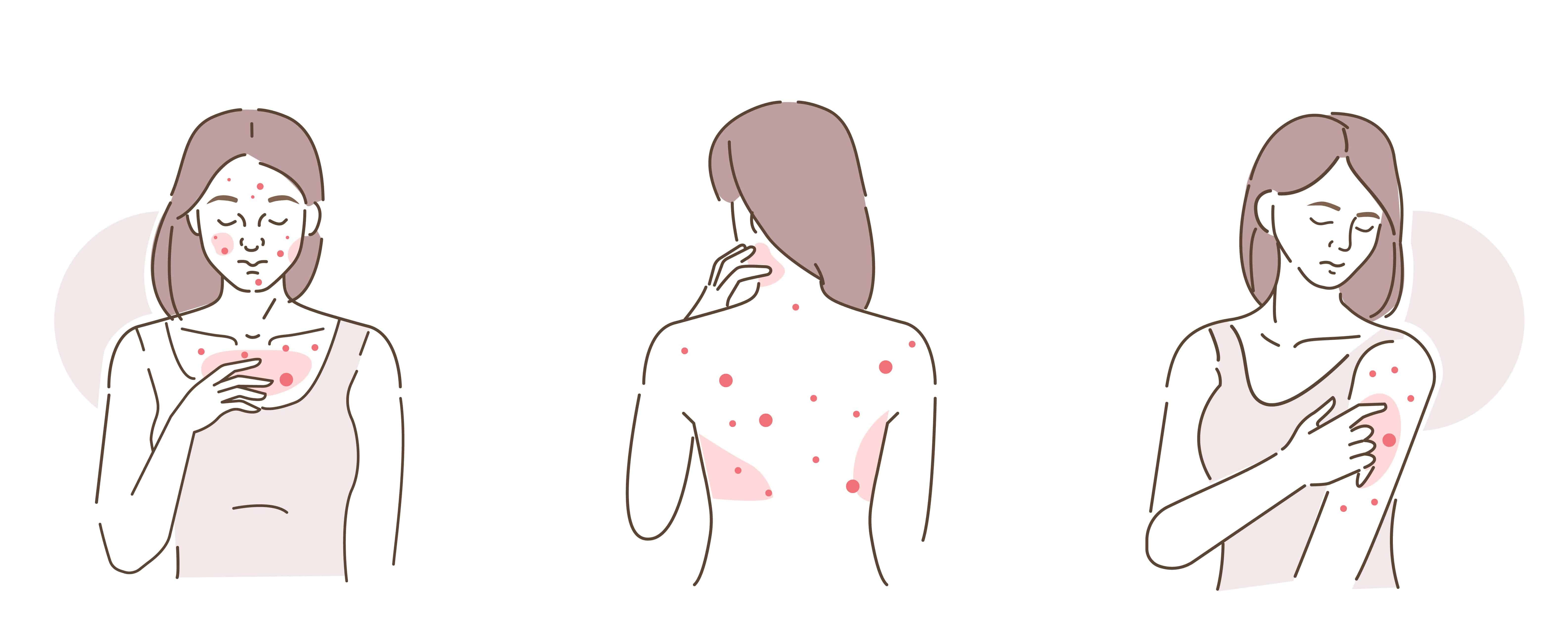 illustration of a lady who has a severe bacne, arm and body acne