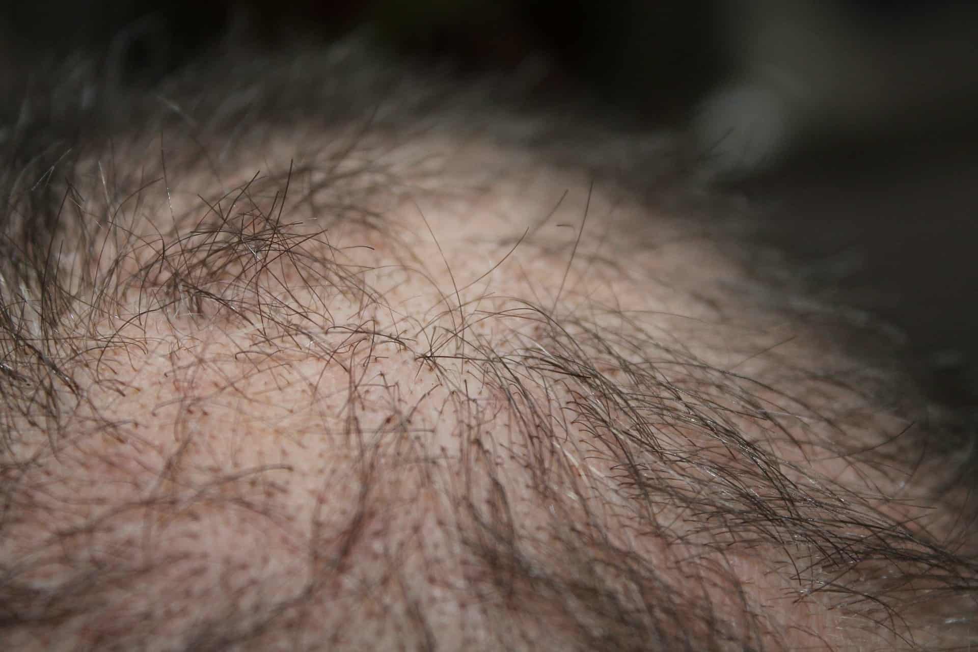a man with hair loss problem with needs to get hair growth treatment