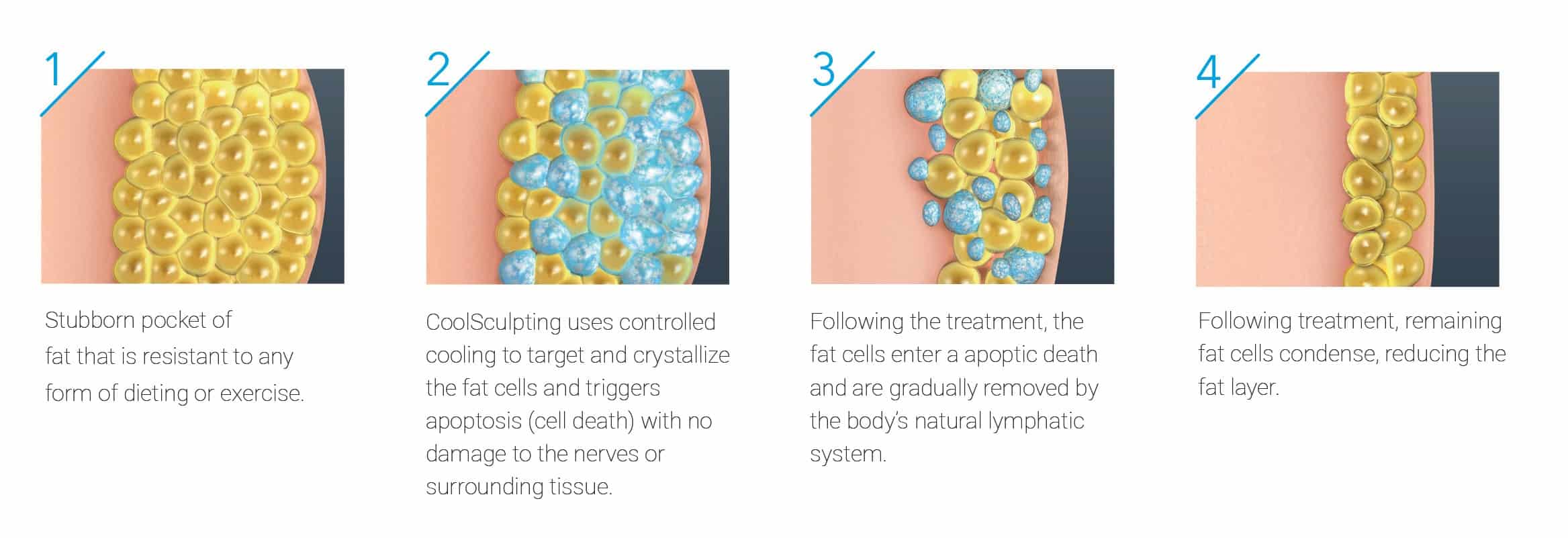 How Does CoolSculpting Work