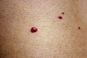 Vascular Lesion Treatment in Singapore | Fotona Laser