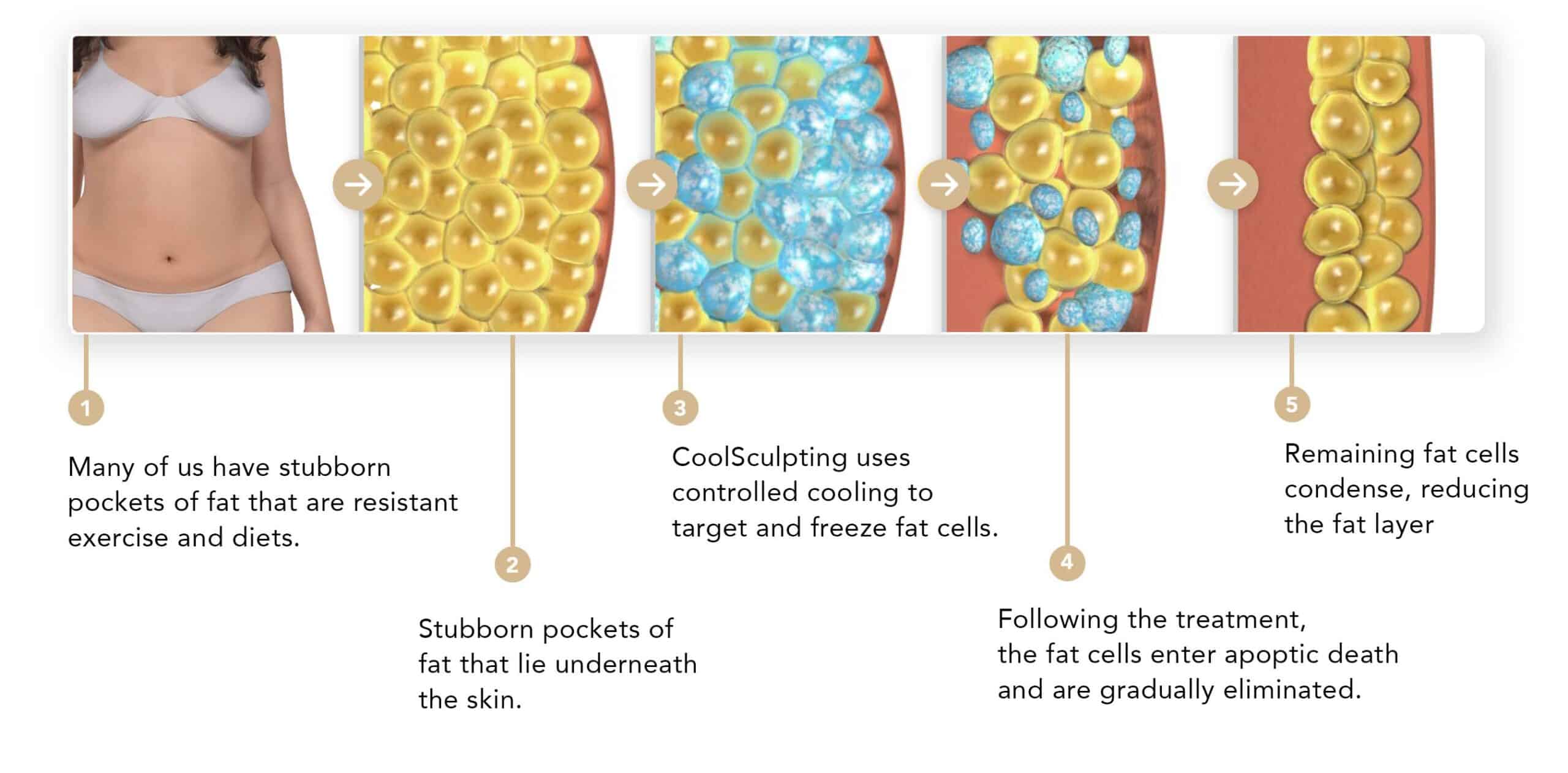 how-coolsculpting-works-singapore