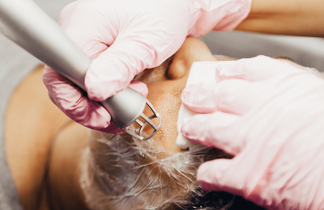 asian_pigmentation_co2_laser_ablative_laser asian_pigmentation_co2_laser_ablative_laser