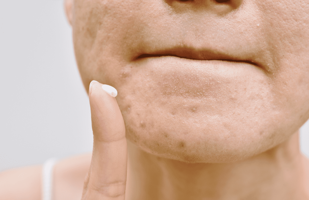 asian_pigmentation_topical_medication asian_pigmentation_topical_medication
