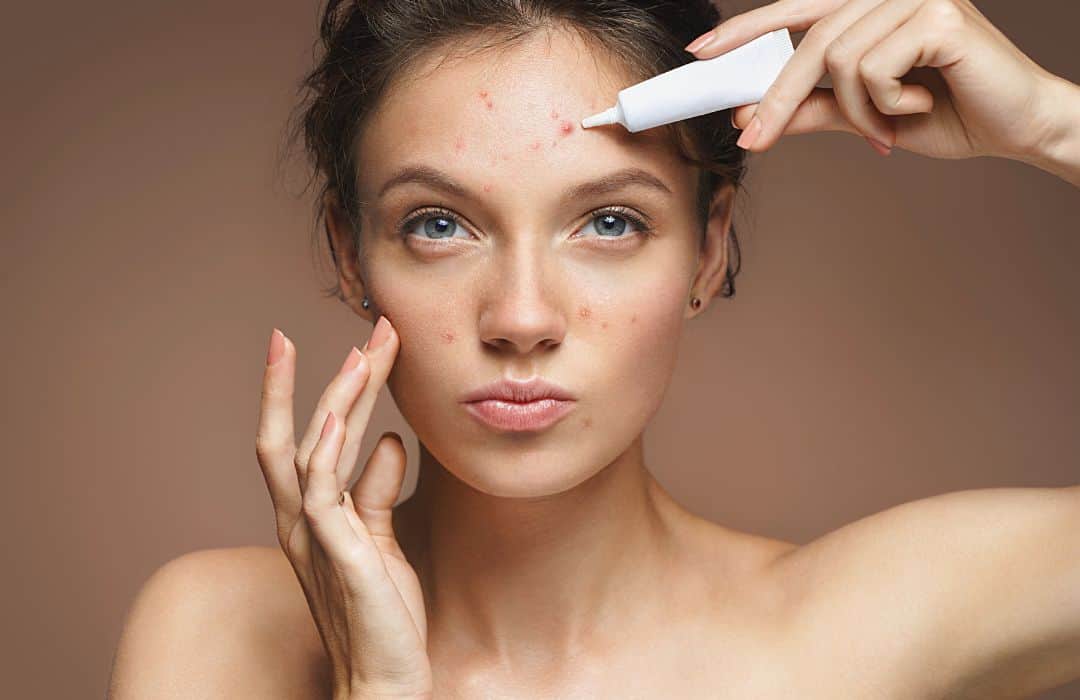 benzoyl-peroxide-acne-spot-treatment