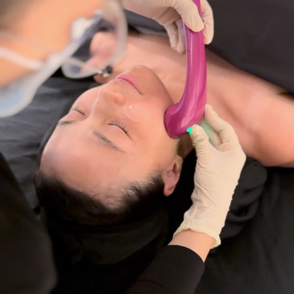 HIFU, Sygmalift, Skin tightening, skin lifting