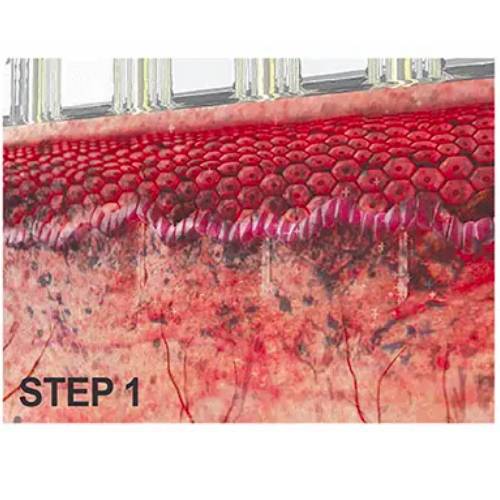 Sylfirm Microneedling melasma treatment
