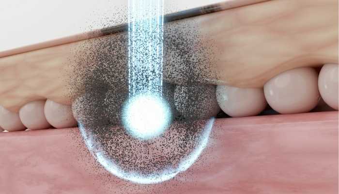 Pico laser Pigmentation treatment