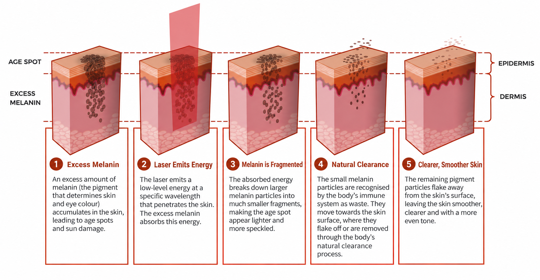 How Lasers Lighten Pigmentation Ensoul Singapore