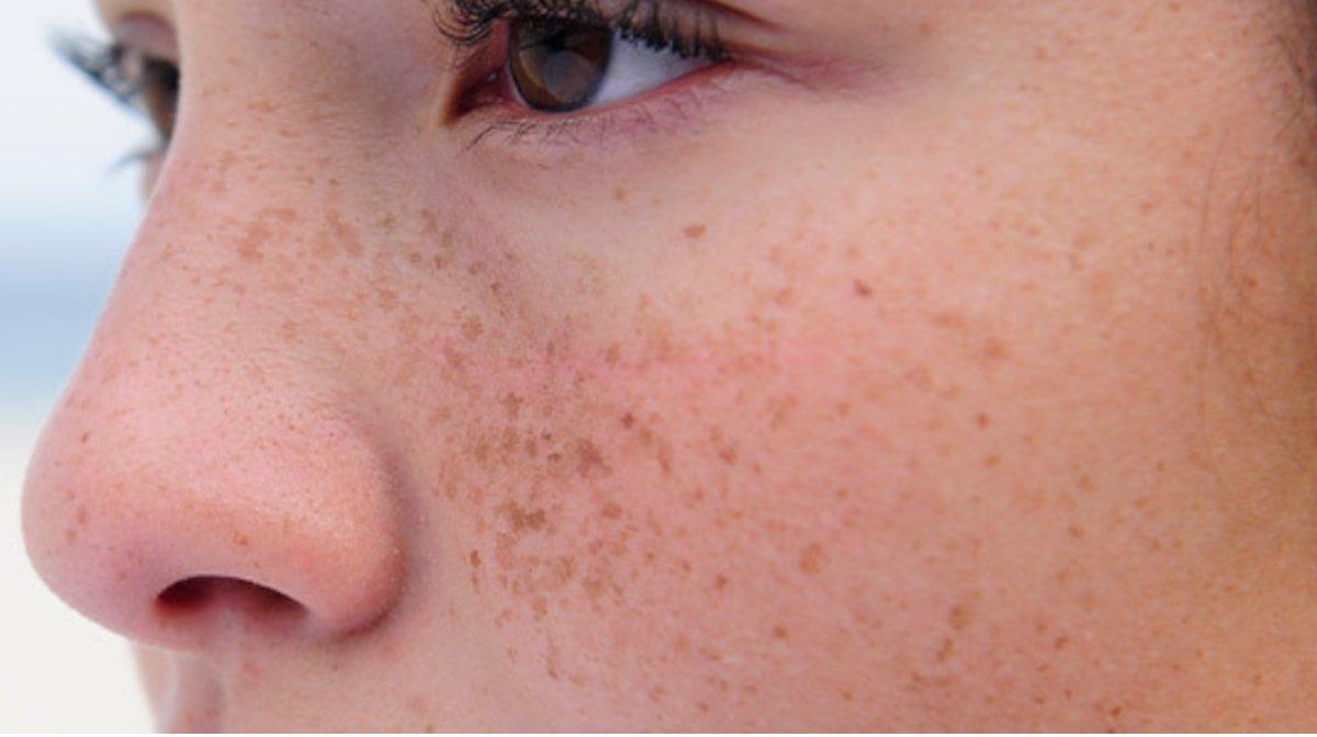 Freckles, sun spots, brown spots, freckles removal, freckles treatment Freckles, sun spots, brown spots, freckles removal, freckles treatment