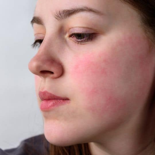 Red Face Flushing Acne Rosacea Spider Veins Treatment Red Face Flushing Acne Rosacea Spider Veins Treatment