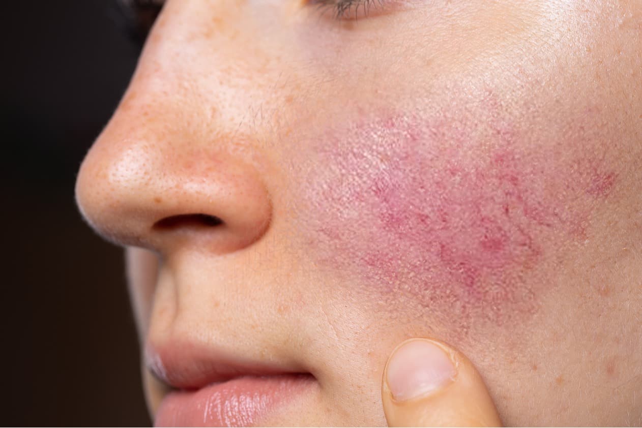 Rosacea treatment removal redness acne veins spider Rosacea treatment removal redness acne veins spider singapore