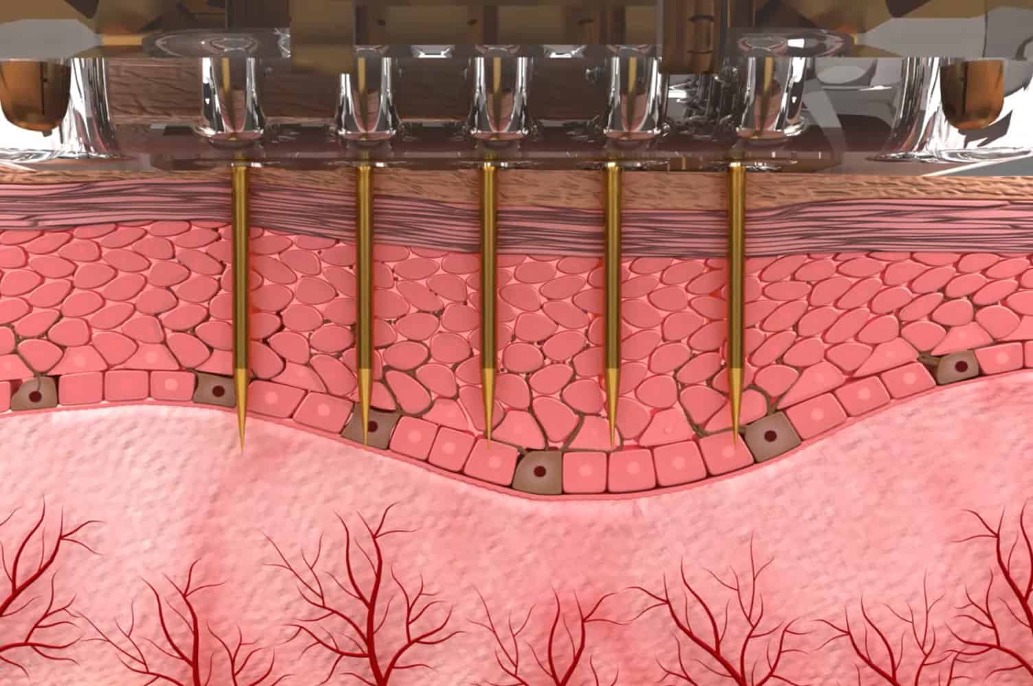 microneedling-sylfirm best acne and acne scars treatment