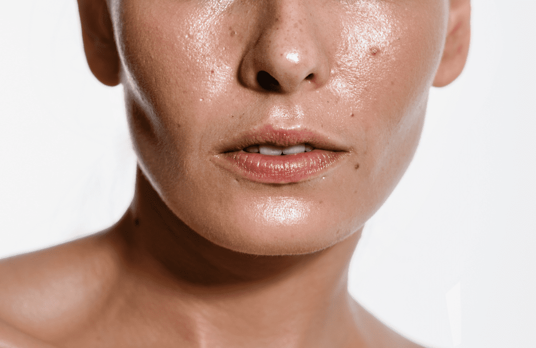 oily skin, acne, pores, large pores, sebum, excessive oil, blackheads, whiteheads, pustules, pus, cystic, cystic acne, nodular acne, acne scars, hyperpigmentation, pigmentation