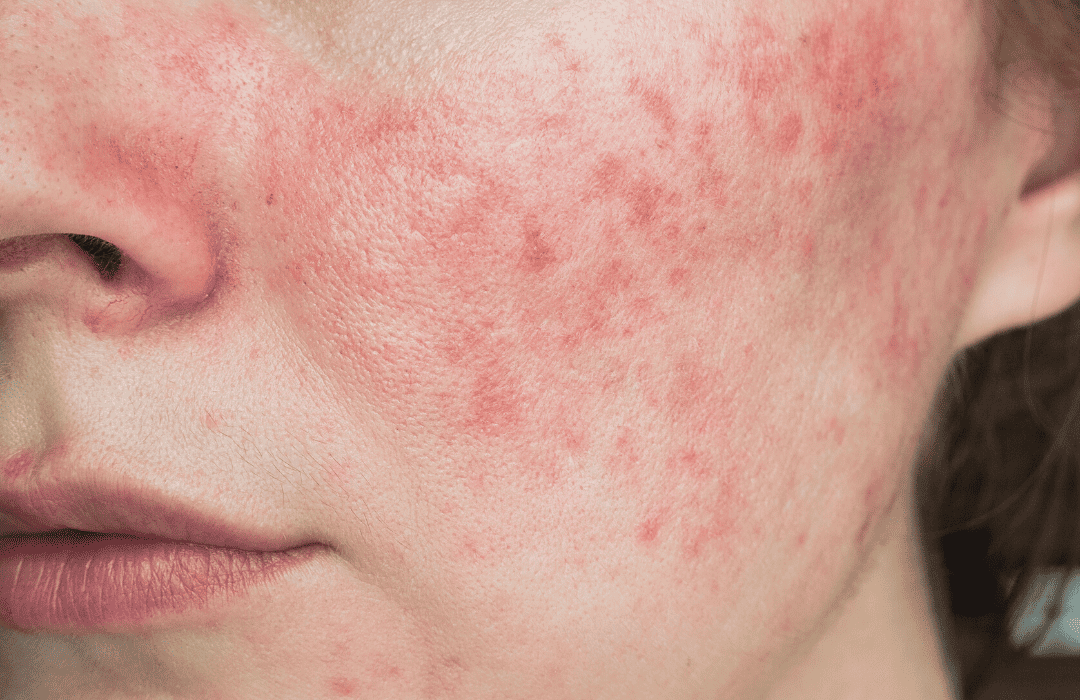 玫瑰痤疮-红斑痤疮-rosacea 玫瑰痤疮-红斑痤疮-rosacea treatment, acne treatment, vascular rosacea, pre rosacea, inflammatory, facial redness, red face,